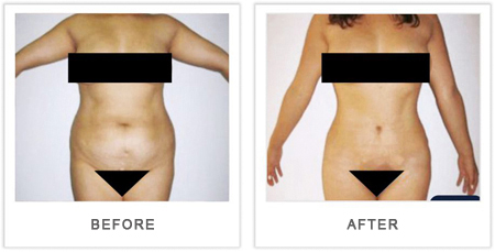 abdominoplastia antes y despues