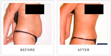 abdominoplastia antes y despues