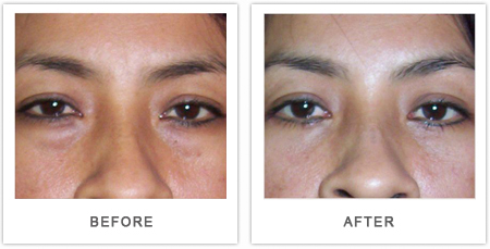 blefaroplastia antes y despues