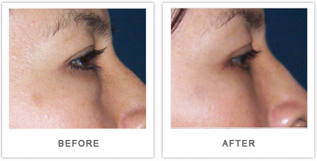 blefaroplastia antes y despues