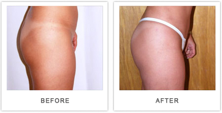 implante de gluteos antes y despues