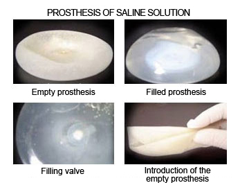 protesis