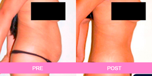 abdominoplastiaantes y despues