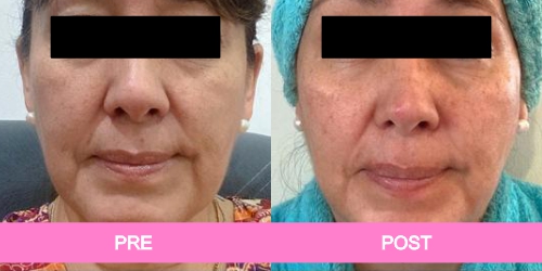 implante pantorrillas antes y despues