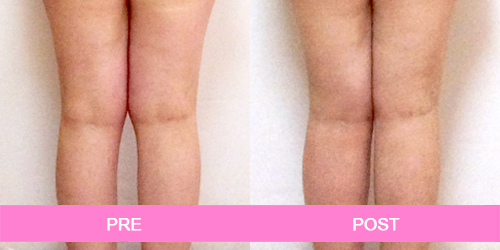 implante pantorrillas antes y despues