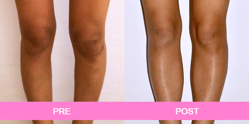 implante pantorrillas antes y despues