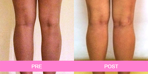 implante pantorrillas antes y despues