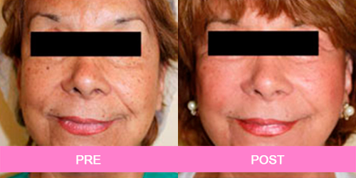 lifting facial antes y despues