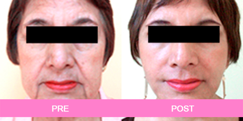 lifting facial antes y despues