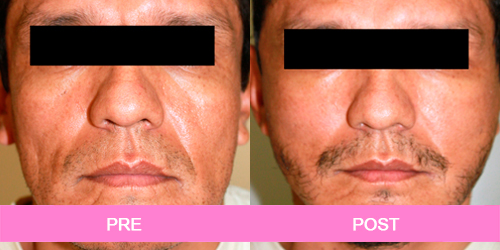 lifting facial antes y despues