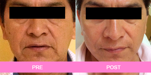 lifting facial antes y despues