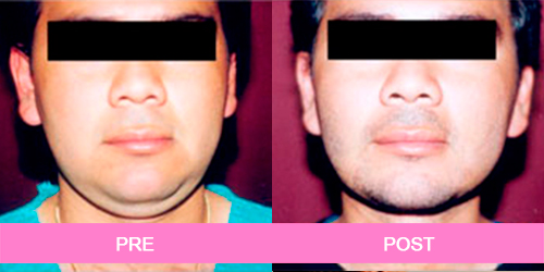 lipoescultura papada antes y despues