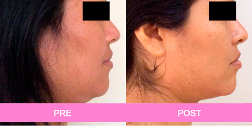lipoescultura papada antes y despues
