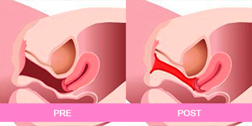 rejuvenecimiento vaginal antes y despues