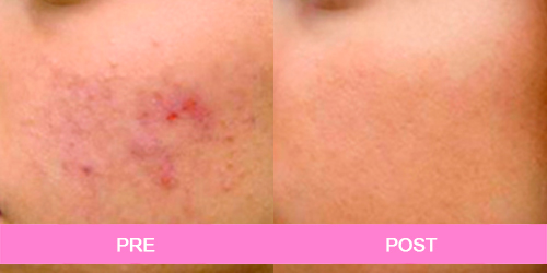 acne antes y despues