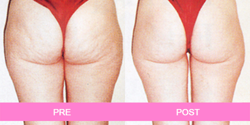 elimina celulitis antes y despues