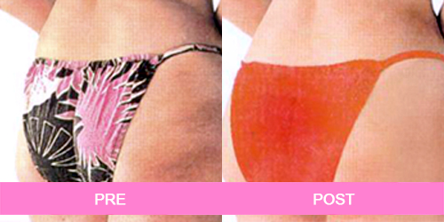 elimina celulitis antes y despues