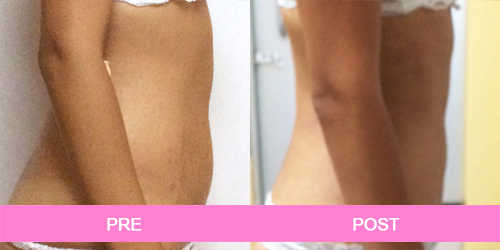 elimina estrias antes y despues