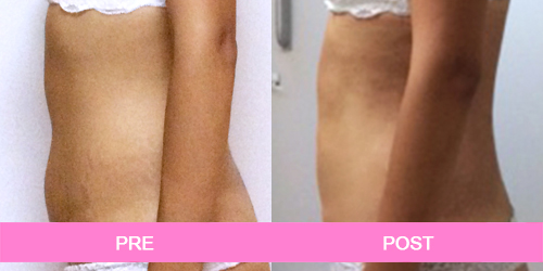 elimina estrias antes y despues