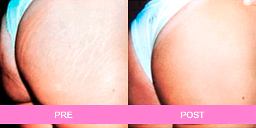elimina estrias antes y despues