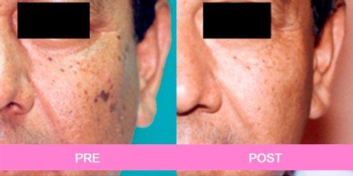 elimina manchas antes y despues