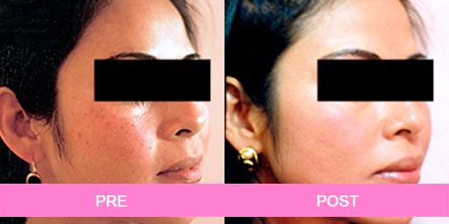 elimina manchas antes y despues