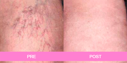 varices antes y despues