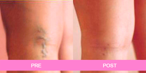 varices antes y despues