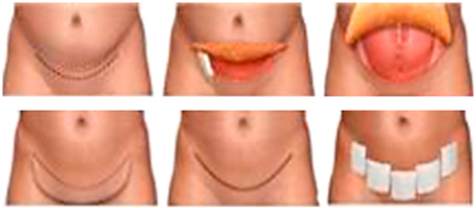 mini abdominoplastia antes y despues